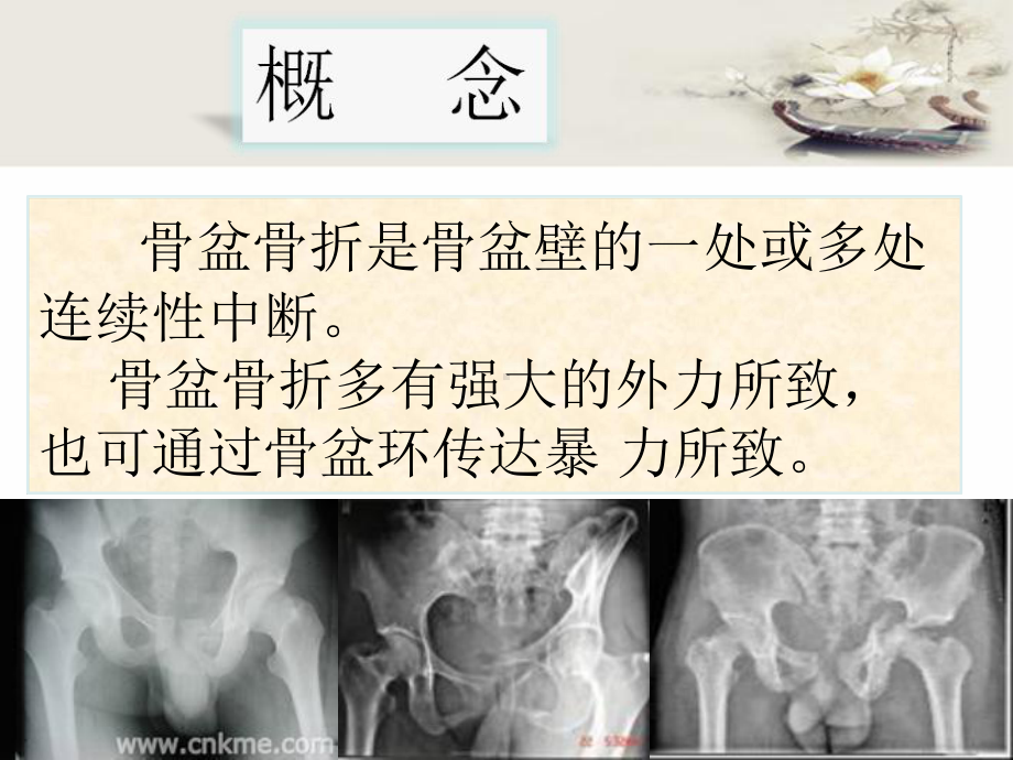 骨盆骨折护理-课件.ppt_第3页