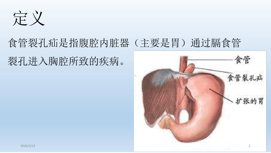 食管裂孔疝护理查房课件.ppt_第2页