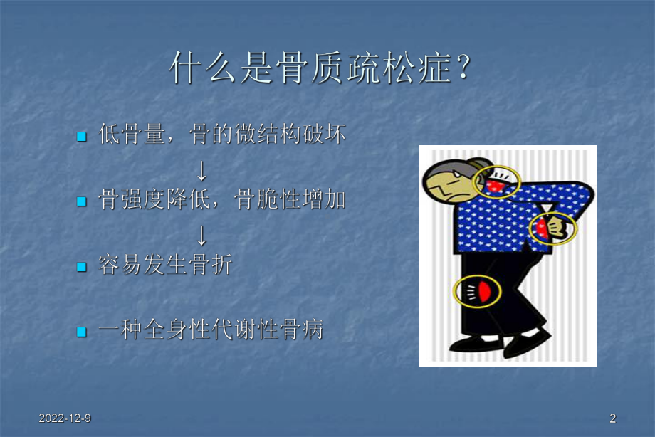 骨质疏松症防治-课件.ppt_第2页