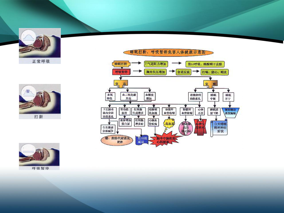 阻塞性睡眠呼吸暂停综合征的健康教育汇编课件.ppt_第2页