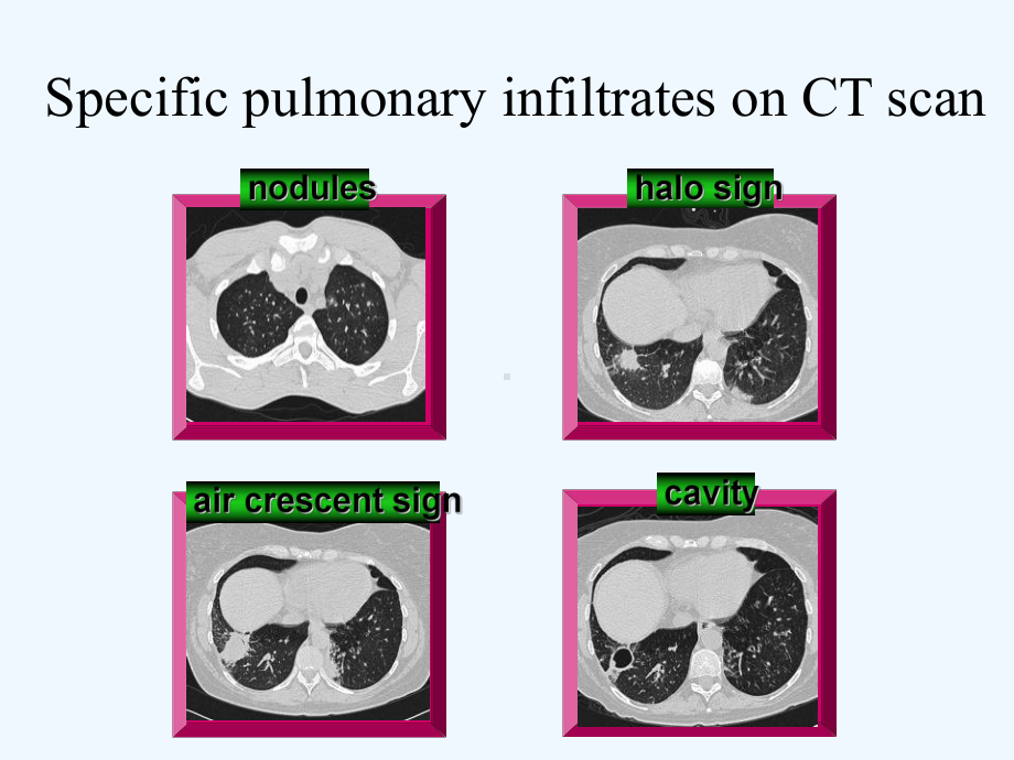 胡必杰课件肺隐球菌感染的影像学改变.ppt_第3页