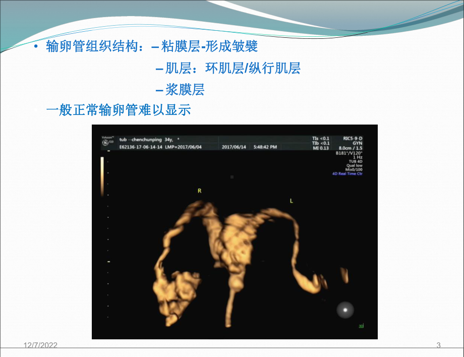 输卵管炎性疾病的超声诊断参考课件.ppt_第3页