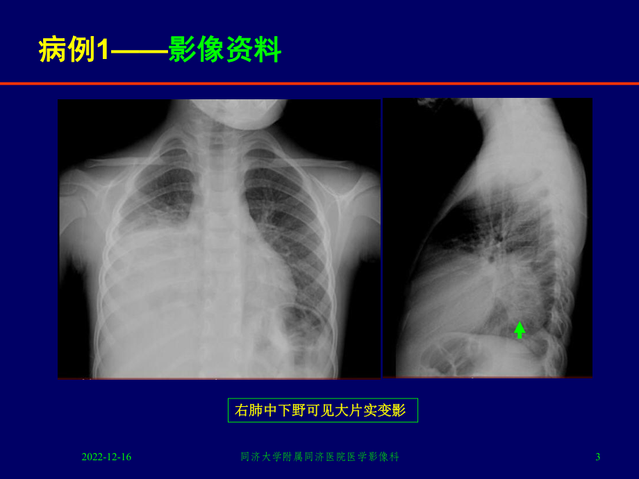 胸部少见罕见疾病影像诊断课件.ppt_第3页