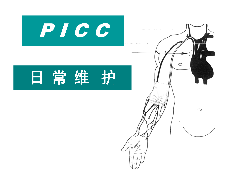 PICC导管维护PPT课件.ppt_第1页