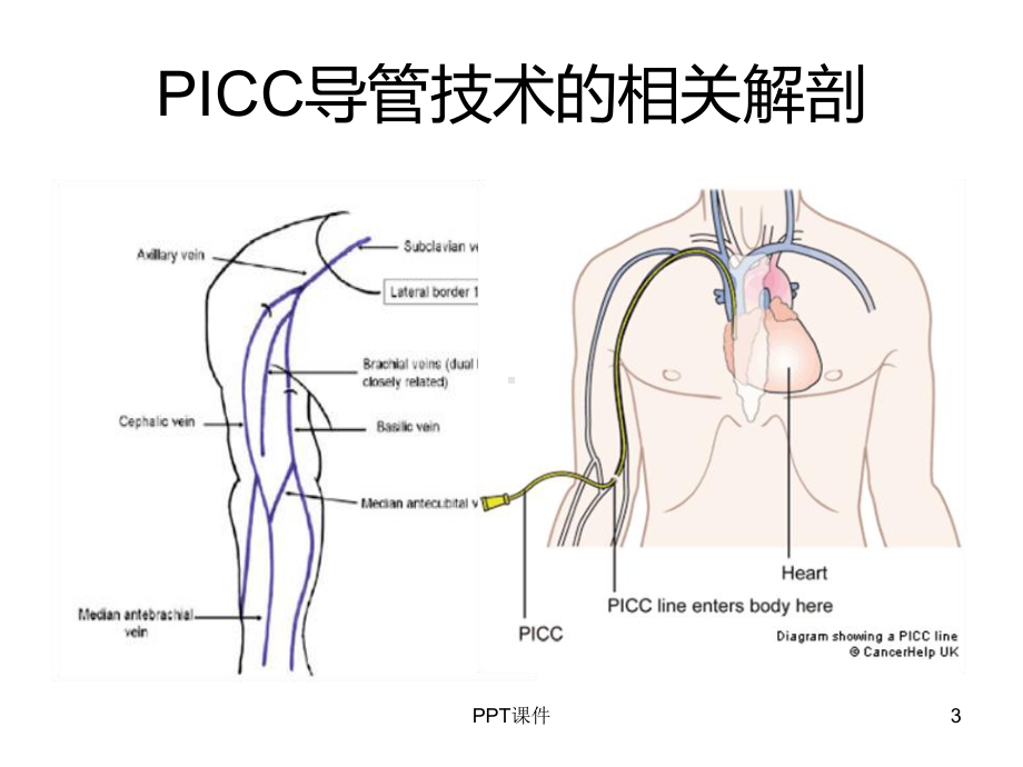 PICC导管头端定位与异常位置-ppt课件.ppt_第3页