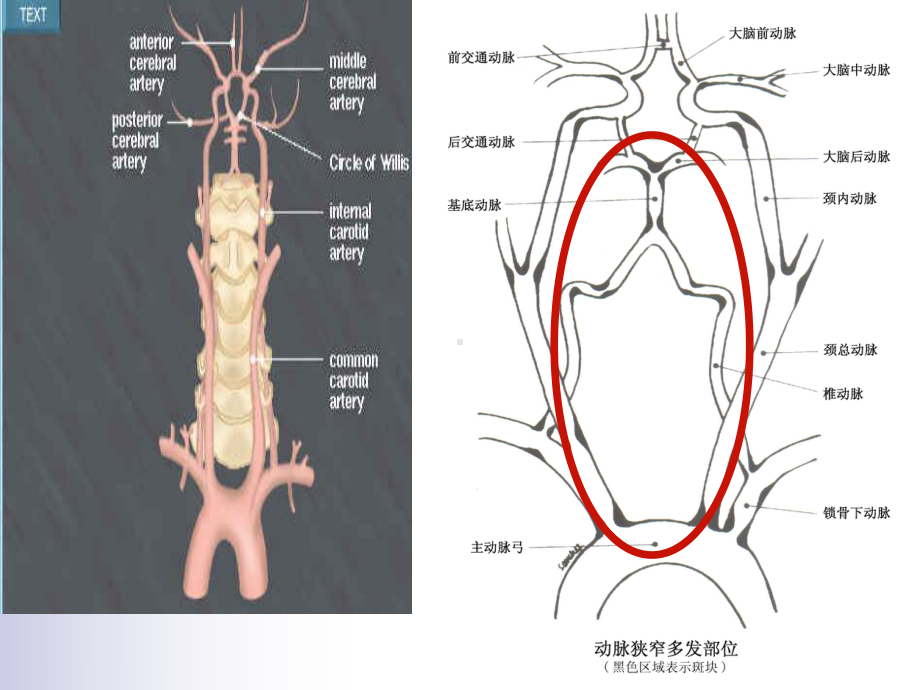 后循环缺血PPT课件(同名66089).ppt_第3页