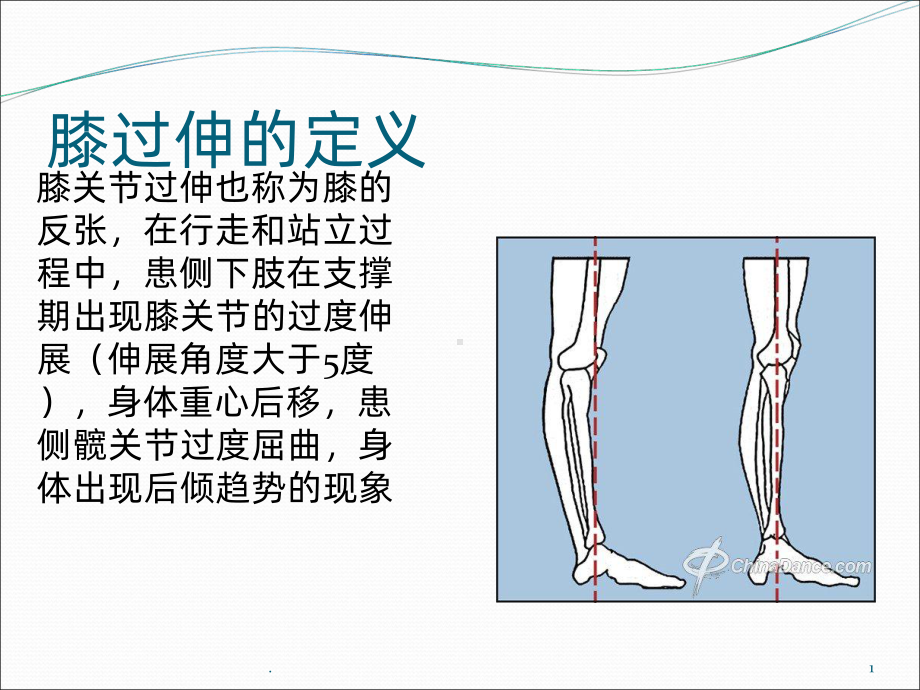 膝过伸的原因和训练方法ppt课件.ppt_第1页