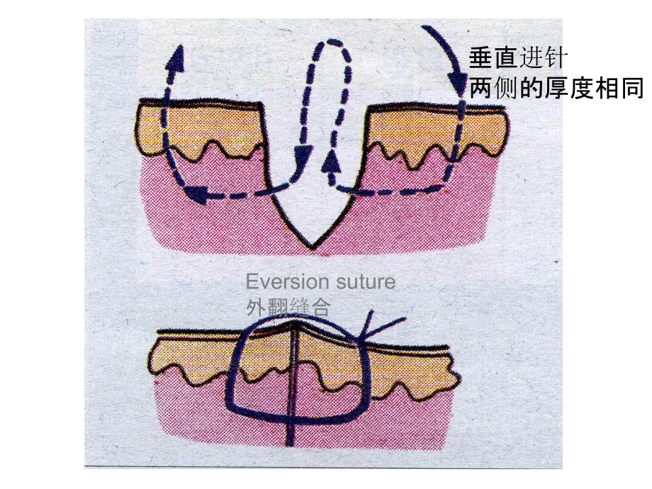 最新种植牙常用缝合技术图解主题讲座课件.ppt_第2页