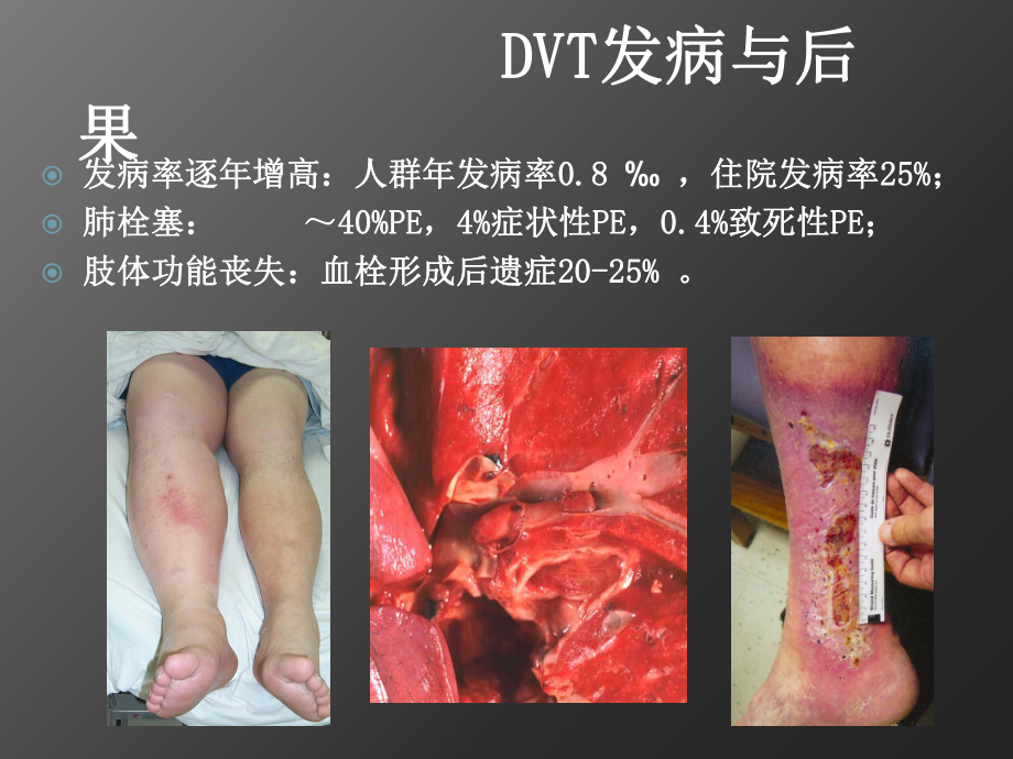 最新DVT的导管溶栓技术主题讲座课件.ppt_第1页