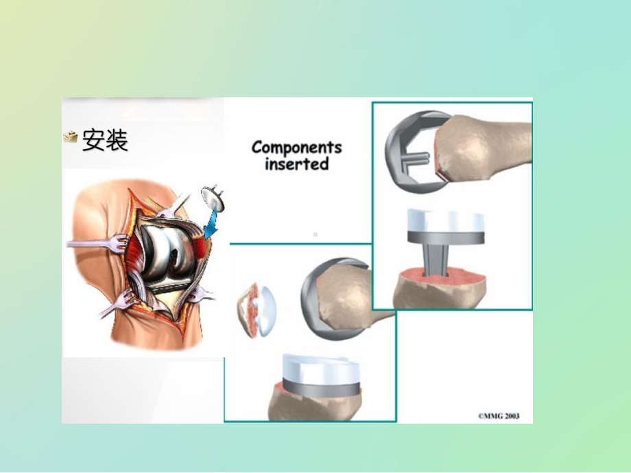 全膝关节置换ppt课件.pptx_第2页