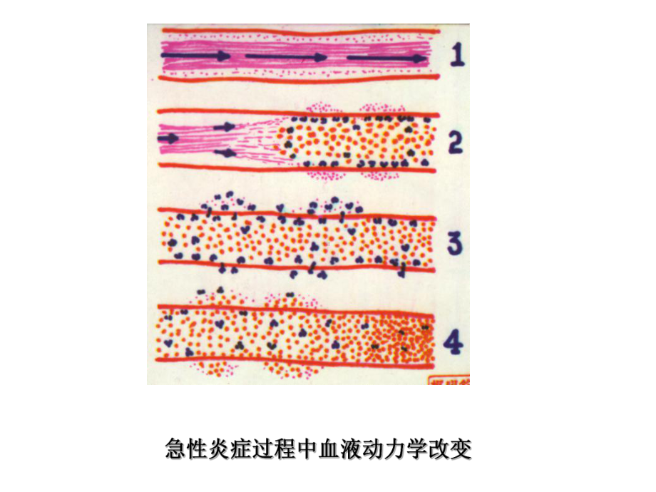 病理-炎症-图片课件.ppt_第2页