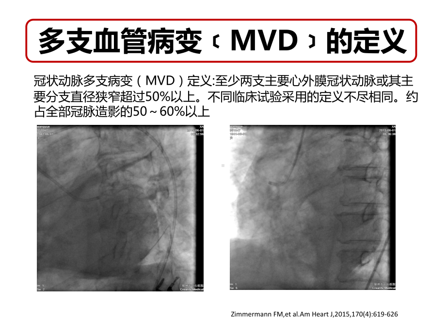 冠脉多支病变最佳血运重建策略课件.ppt_第2页