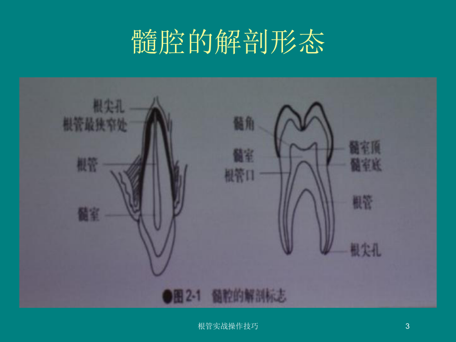 根管实战操作技巧培训课件.ppt_第3页