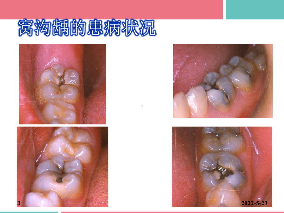 窝沟封闭操作注意要点和质量控制-ppt课件.ppt_第3页