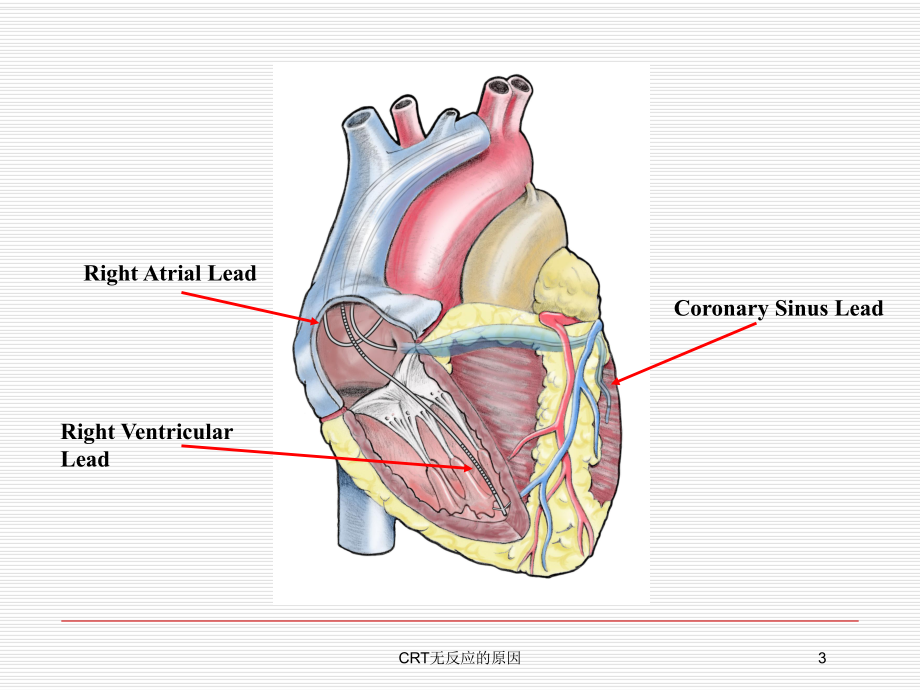 CRT无反应的原因培训课件.ppt_第3页