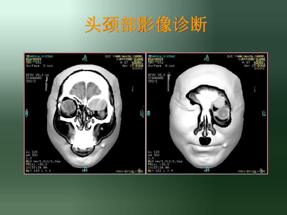 精选眶部影像课件资料.ppt_第1页