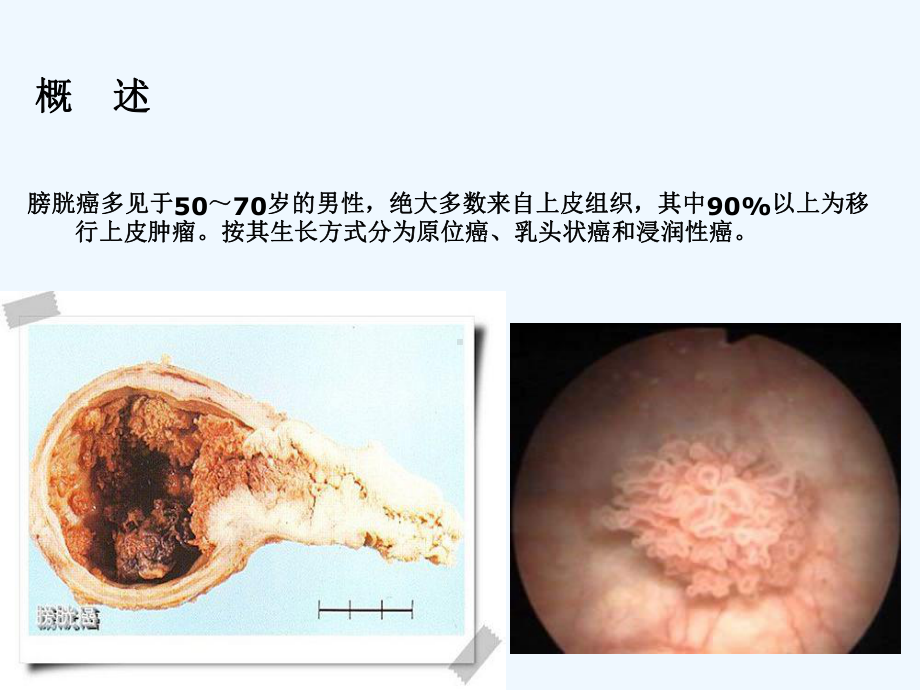 膀胱癌护理查房3课件.ppt_第2页