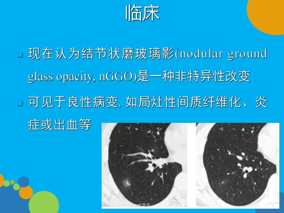 肺磨玻璃密度病变初步探讨-ppt课件.ppt_第3页