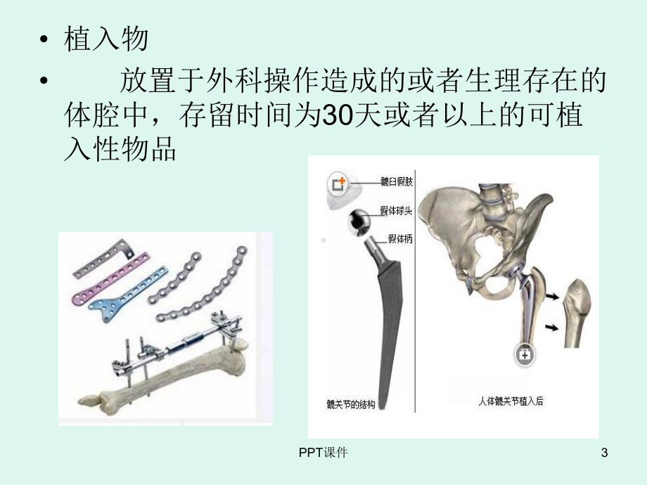 外来器械及植入物特点和管理要求-ppt课件.ppt_第3页