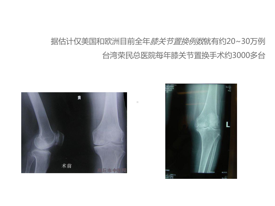 膝关节置换术-ppt课件.ppt_第2页