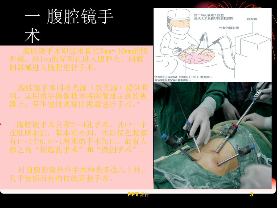 腹腔镜的操作标准-ppt课件.ppt_第3页