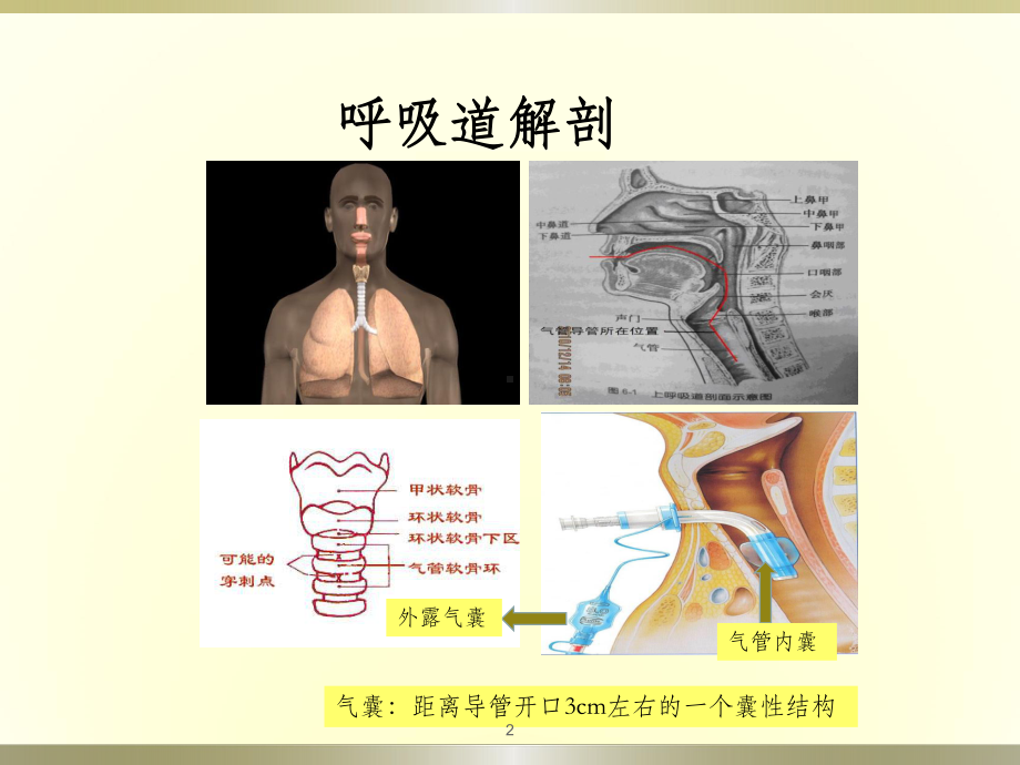 气管套管的气囊管理PPT课件.ppt_第2页