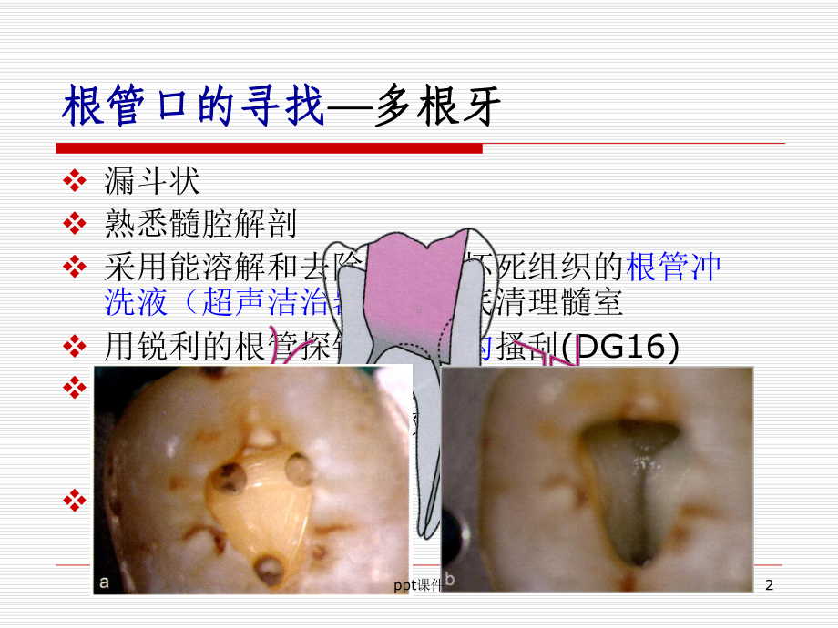 钙化根管的预备-ppt课件.ppt_第2页