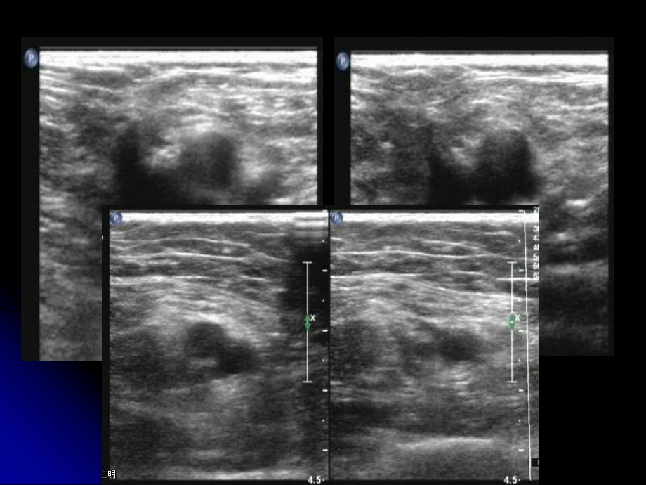上下肢动静脉的超声检查-PPT课件.ppt_第3页