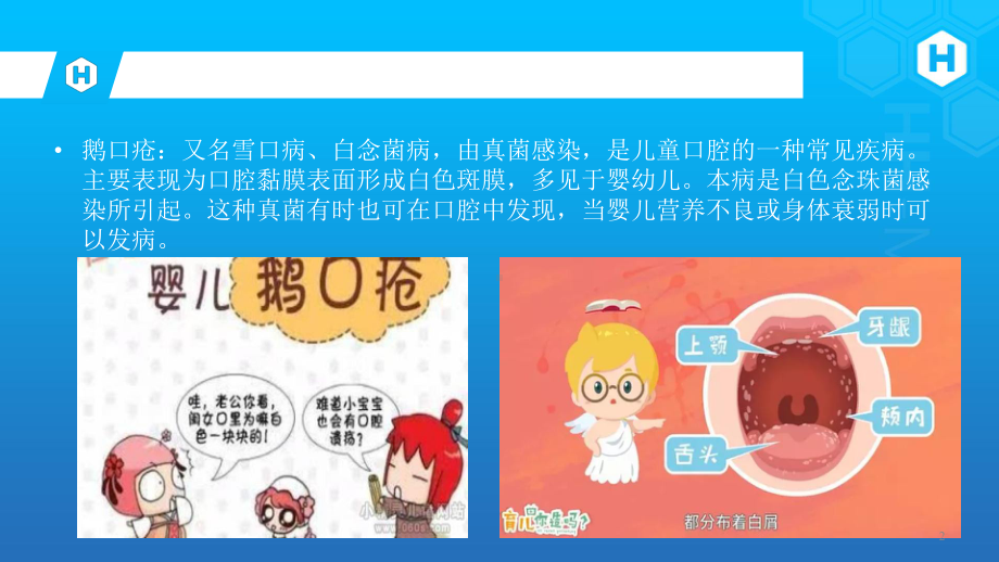 婴幼儿鹅口疮PPT课件.ppt_第2页