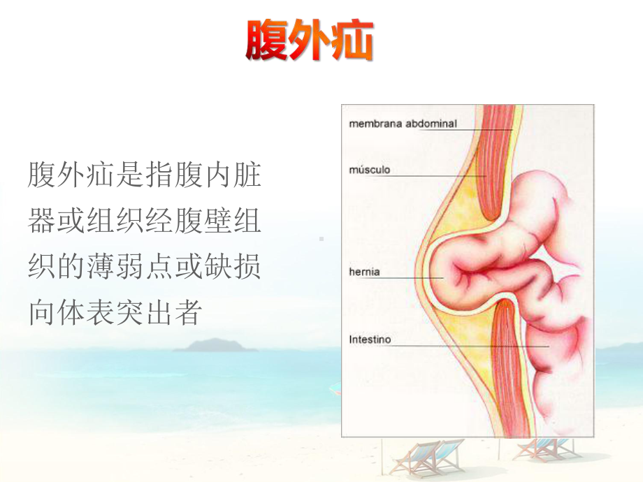 腹外疝-ppt课件.ppt_第3页