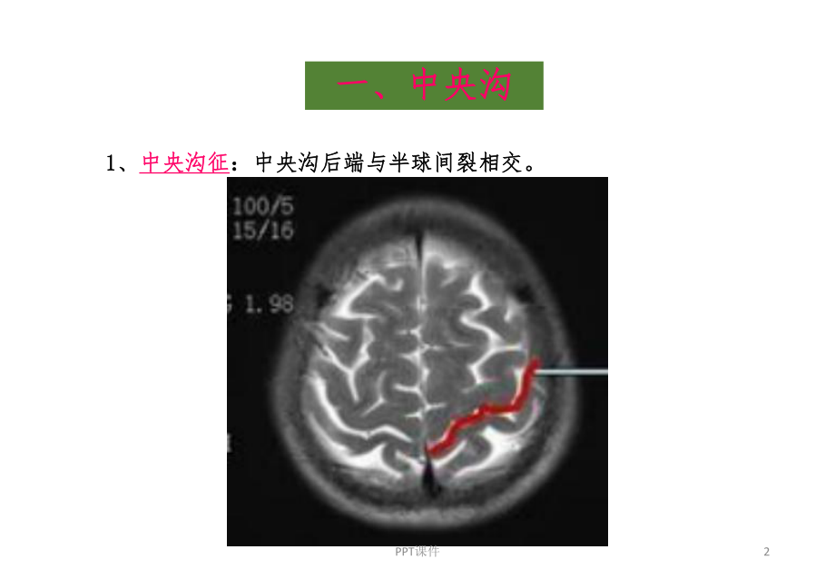 脑沟回特殊征象-ppt课件.ppt_第2页