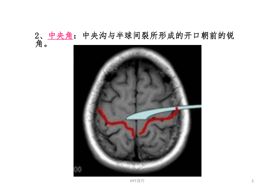 脑沟回特殊征象-ppt课件.ppt_第3页