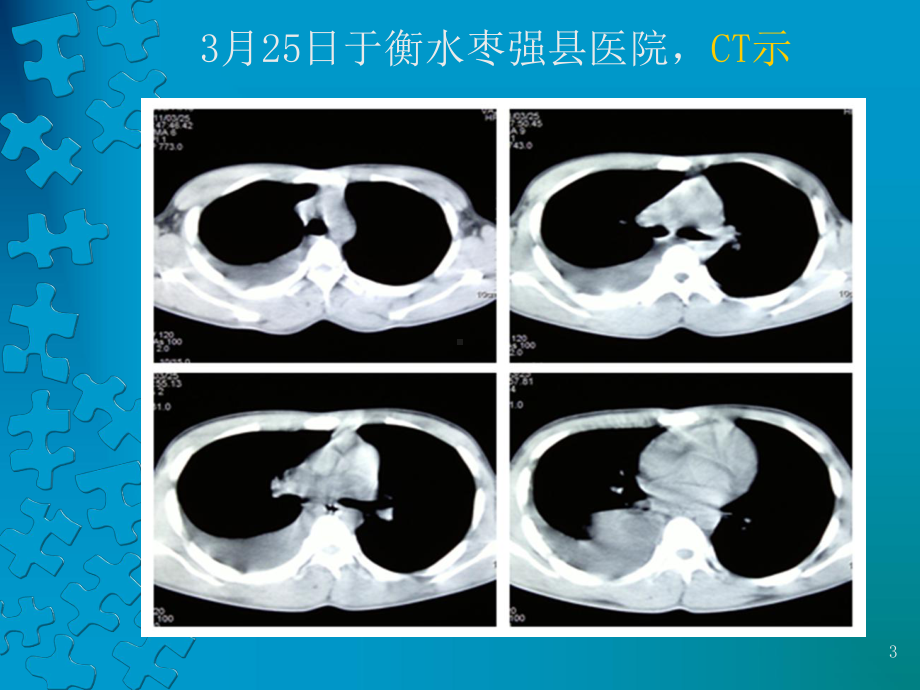 肠源性囊肿PPT课件.ppt_第3页