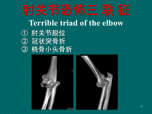 肘恐怖三联征PPT课件.ppt