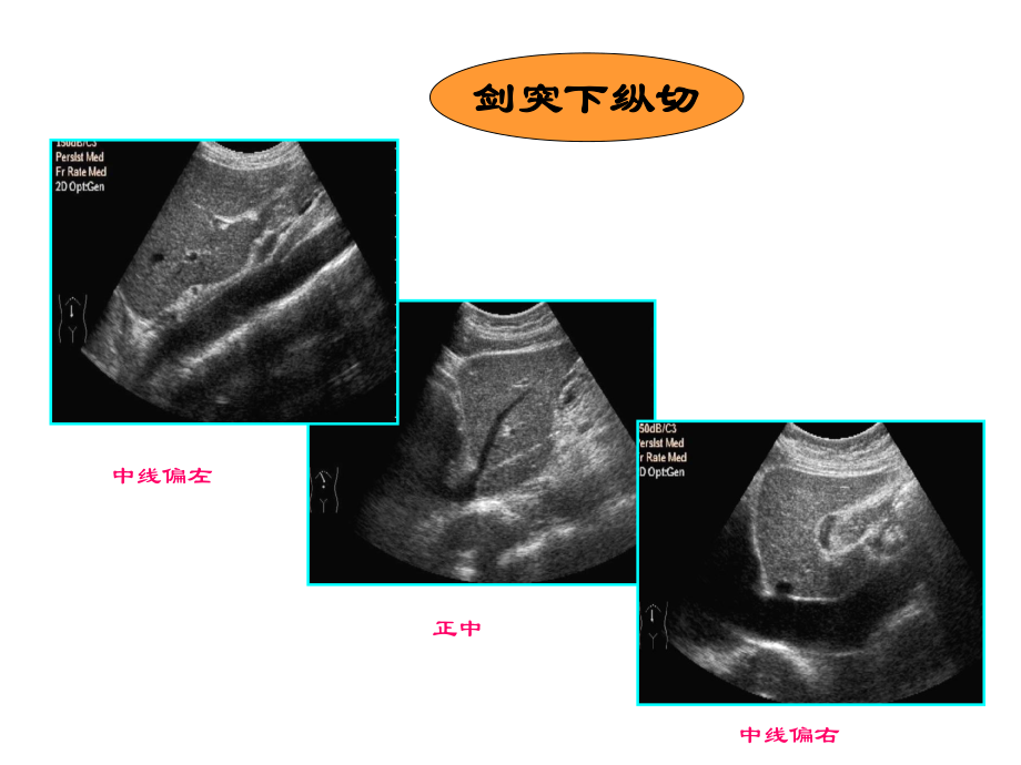 超声肝胆胰脾ppt课件.ppt_第3页