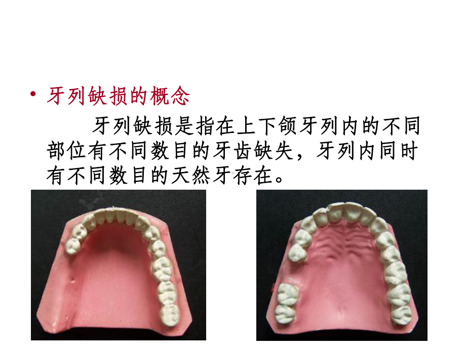 可摘局部义齿-结构ppt课件.ppt_第3页