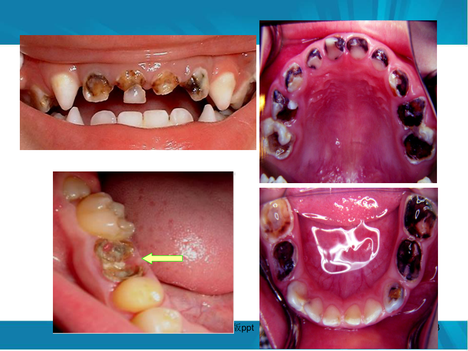 儿童口腔保健PPT课件.ppt_第3页