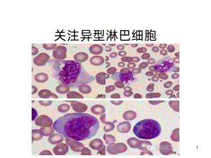 异常淋巴细胞形态课件.ppt