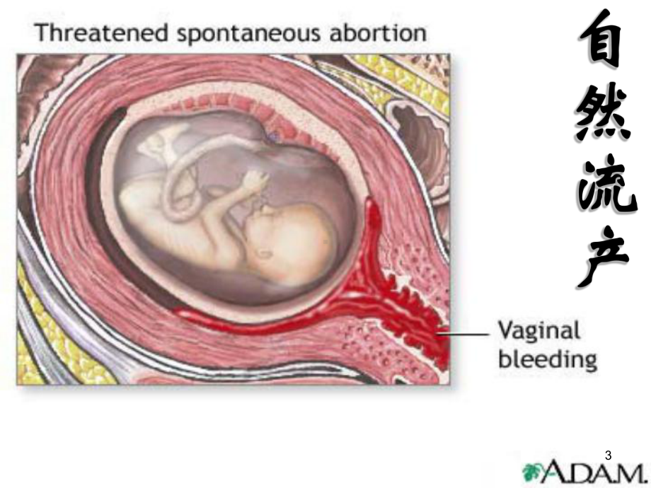 不全流产PPT课件.ppt_第3页