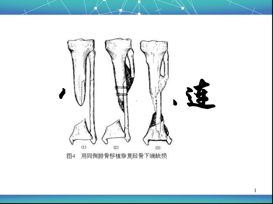 骨不连ppt课件.ppt_第1页