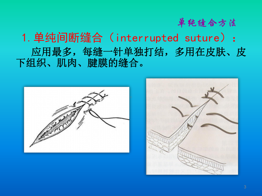 离体肠管吻合PPT课件.ppt_第3页