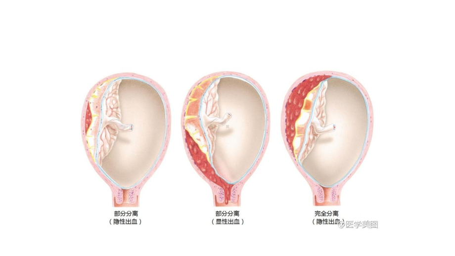 产前出血-ppt课件.pptx_第3页