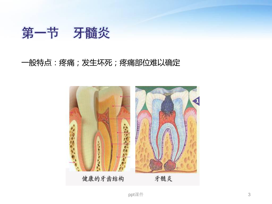 牙髓病-ppt课件.ppt_第3页