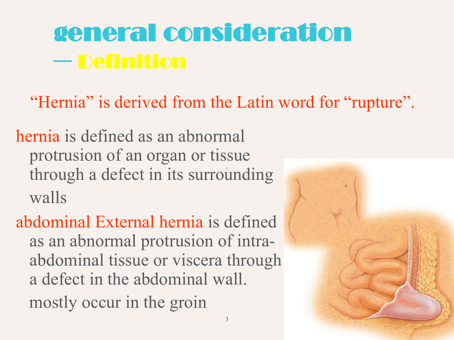 腹外疝-ppt课件(同名725).ppt_第3页
