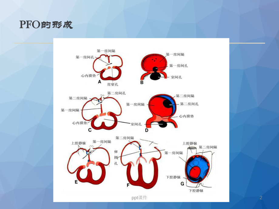 卵圆孔未闭与脑卒中-ppt课件.ppt_第2页