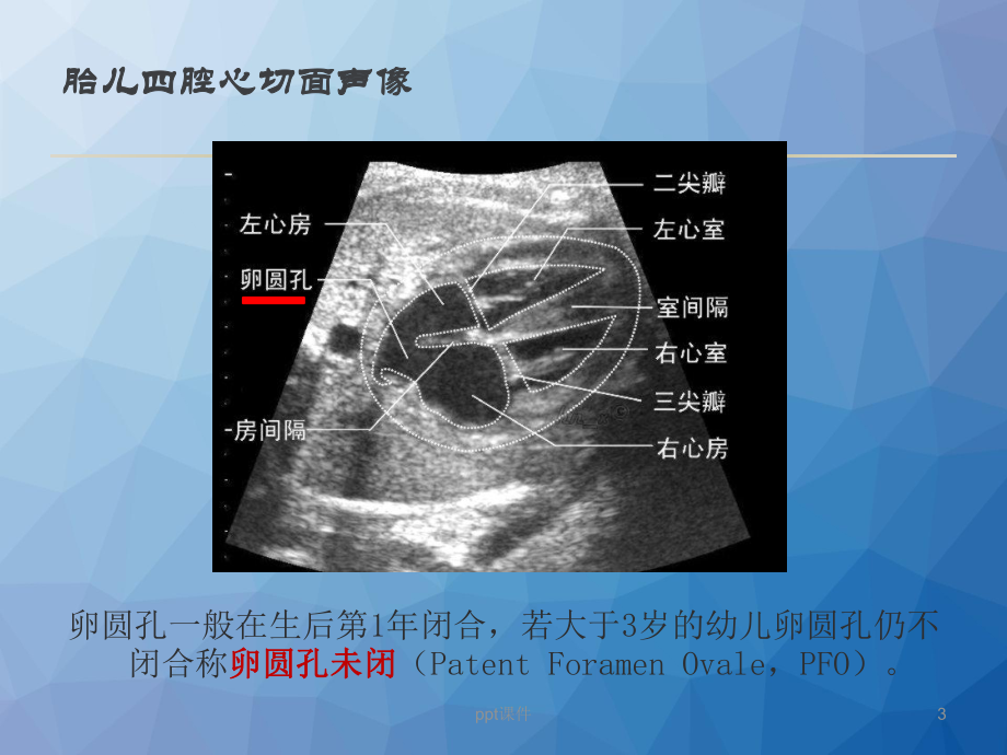 卵圆孔未闭与脑卒中-ppt课件.ppt_第3页