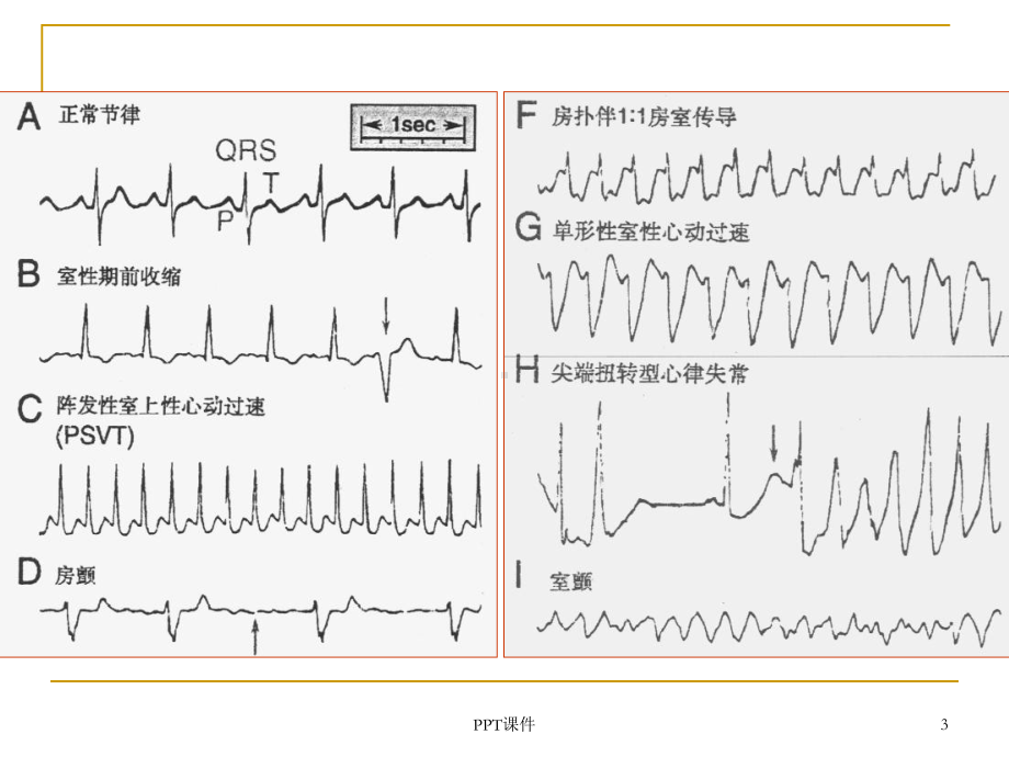 《药理学》抗心率失常药-ppt课件.ppt_第3页