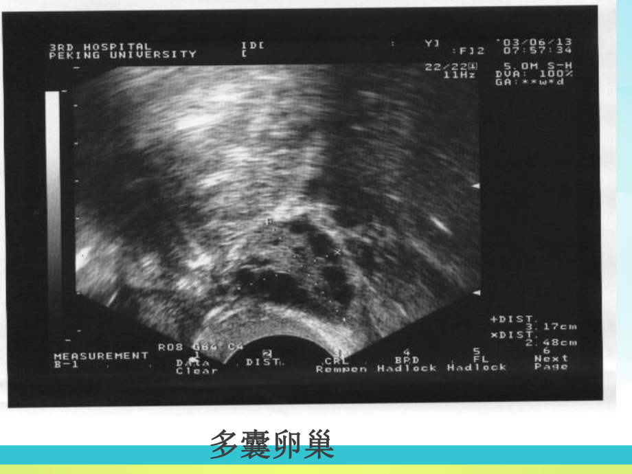 B超监测卵泡发育-ppt课件.ppt_第3页