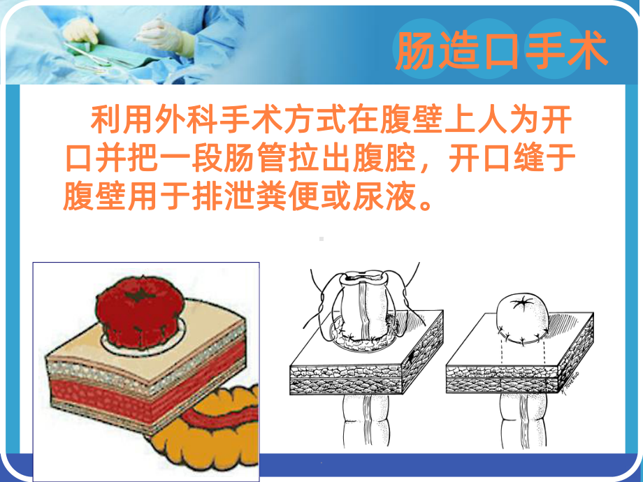 造口术前定位ppt课件(同名495).ppt_第2页