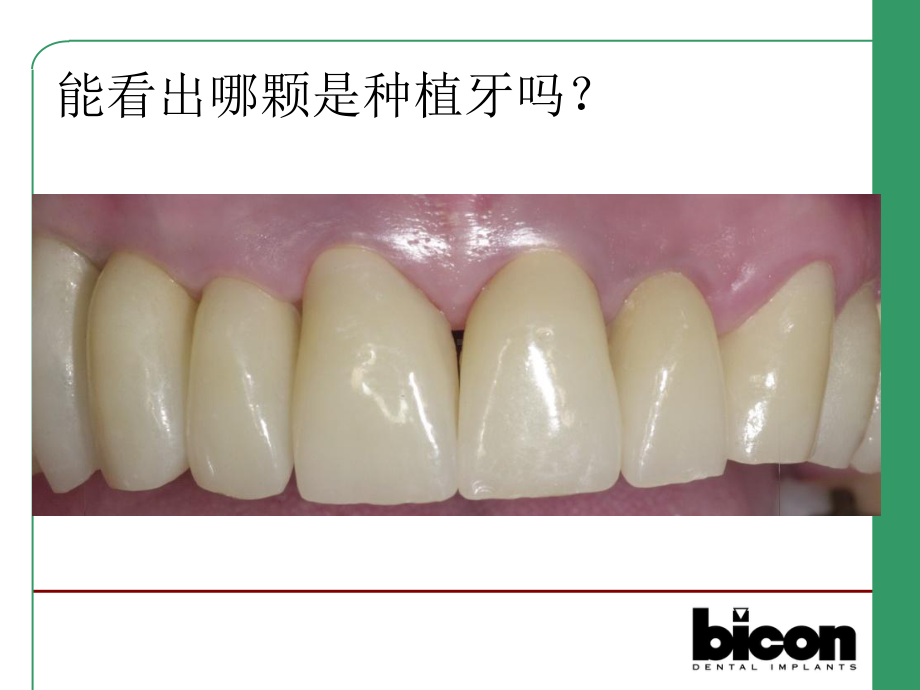 Bicon种植系统修复方式(全套课件213P).ppt_第2页